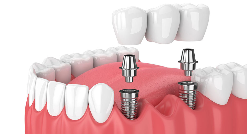 dental-implants-ludhiana