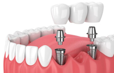 Dental Implants