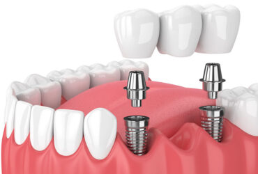 Dental Implants