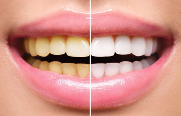 Teeth Whitening