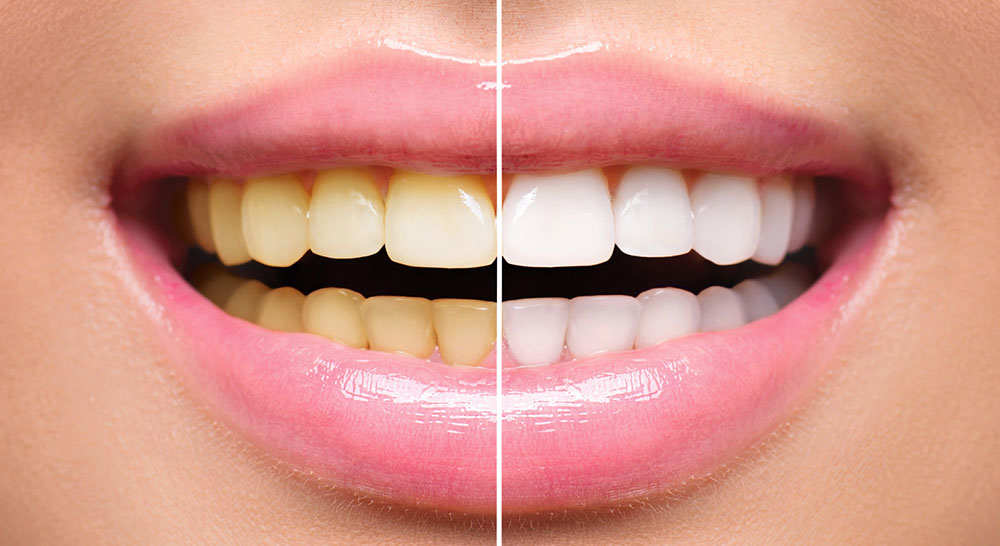 instant-teeth-whitening in Ludhiana