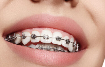 Orthodontics/Braces