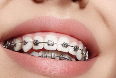 Orthodontics/Braces