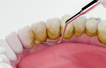 Dental Scaling/Cleaning