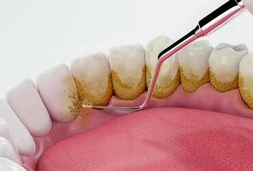 Dental Scaling/Cleaning