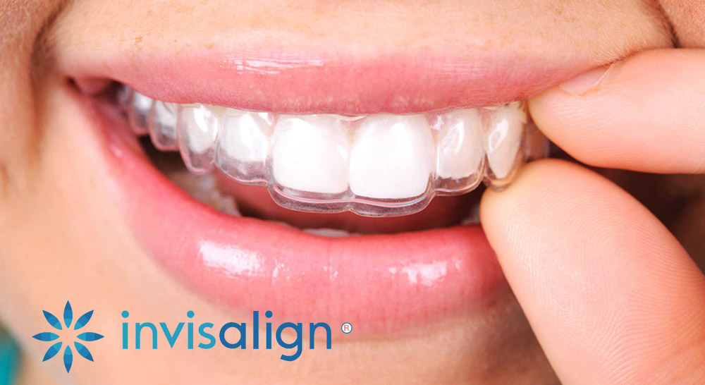 Invisalign®