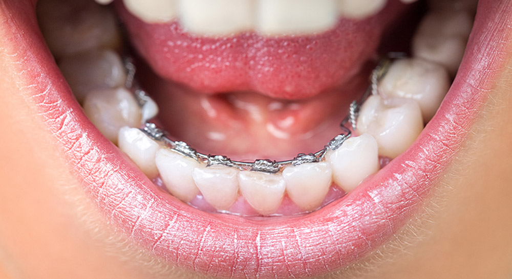 Lingual Braces