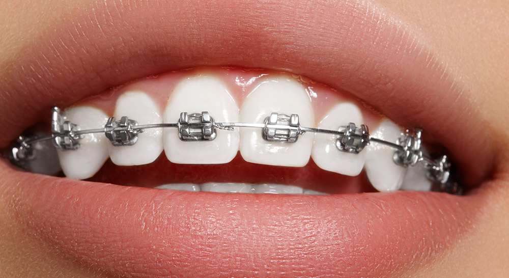 Traditional Braces