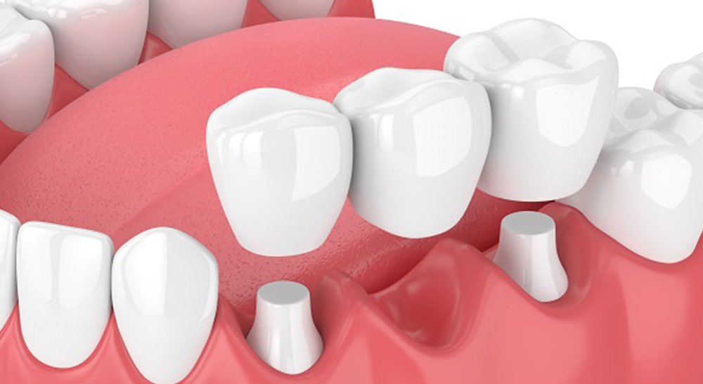 dental bridge treatment in ludhiana