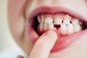 What You Should Know About Your Child Losing Baby Teeth