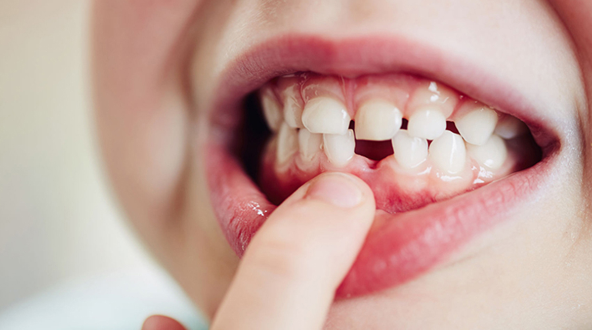 What You Should Know About Your Child Losing Baby Teeth