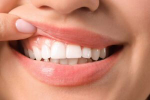 Is Having a Gum Lift Really Necessary for Your Oral Health?