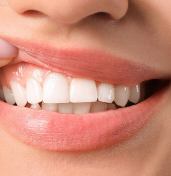 Is Having a Gum Lift Really Necessary for Your Oral Health?