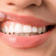 Is Having a Gum Lift Really Necessary for Your Oral Health?