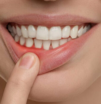 The Correct Way Recommended to Take Care of Your Gums