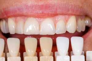 Dental Veneers Cost in Ludhiana: Everything You Need to Know