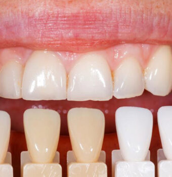 Dental Veneers Cost in Ludhiana: Everything You Need to Know