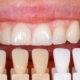 Dental Veneers Cost in Ludhiana: Everything You Need to Know