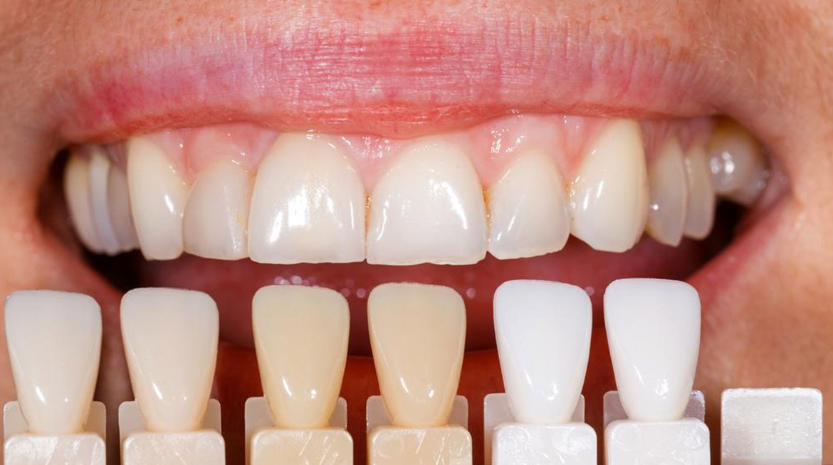 Dental Veneers Cost in Ludhiana: Everything You Need to Know