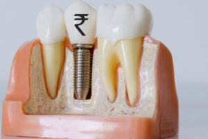 Dental Implant Cost in Ludhiana