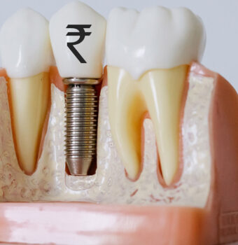 Dental Implant Cost in Ludhiana