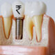 Dental Implant Cost in Ludhiana