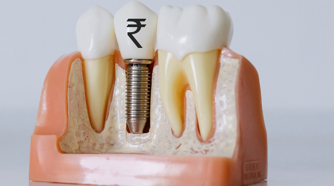 Dental Implant Cost in Ludhiana