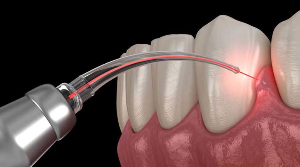 laser gum treatment in Ludhiana