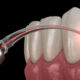 Dental Laser Gum Treatment in Ludhiana