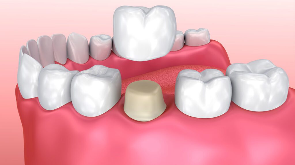 teeth cap cost in ludhiana dent arcs