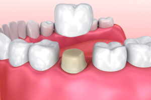 Tooth Cap Cost in Ludhiana