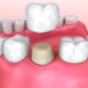 Tooth Cap Cost in Ludhiana