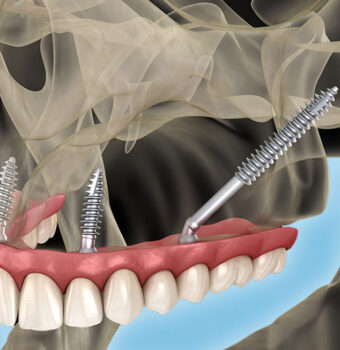 Zygomatic Implants Cost in Ludhiana