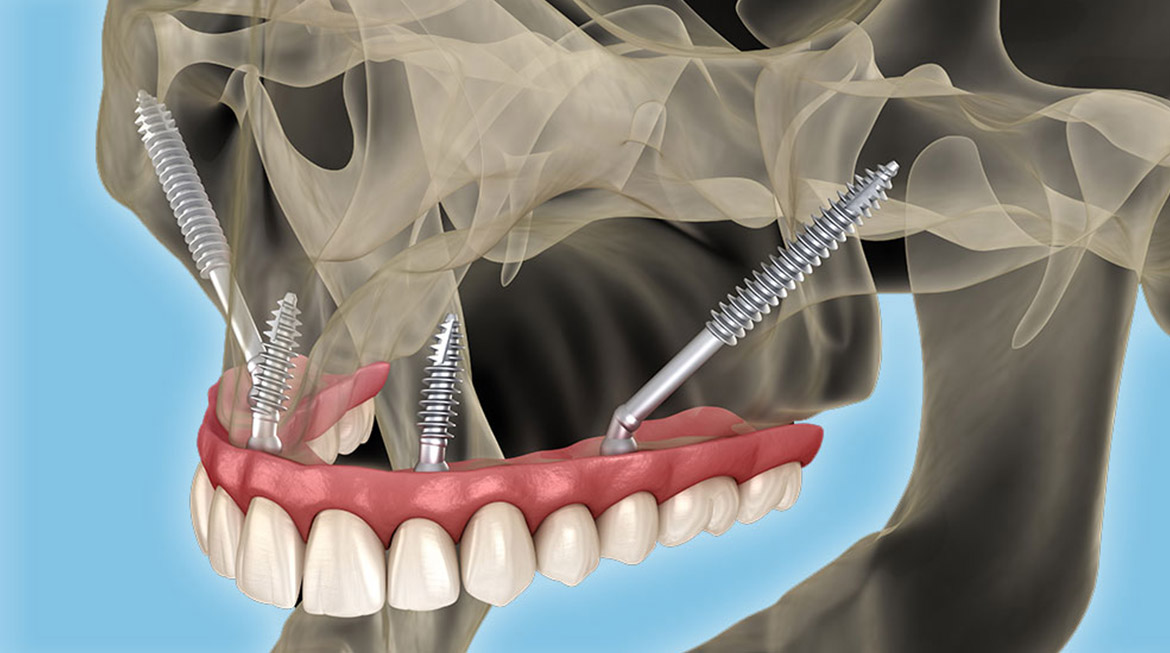 Zygomatic Implants Cost in Ludhiana