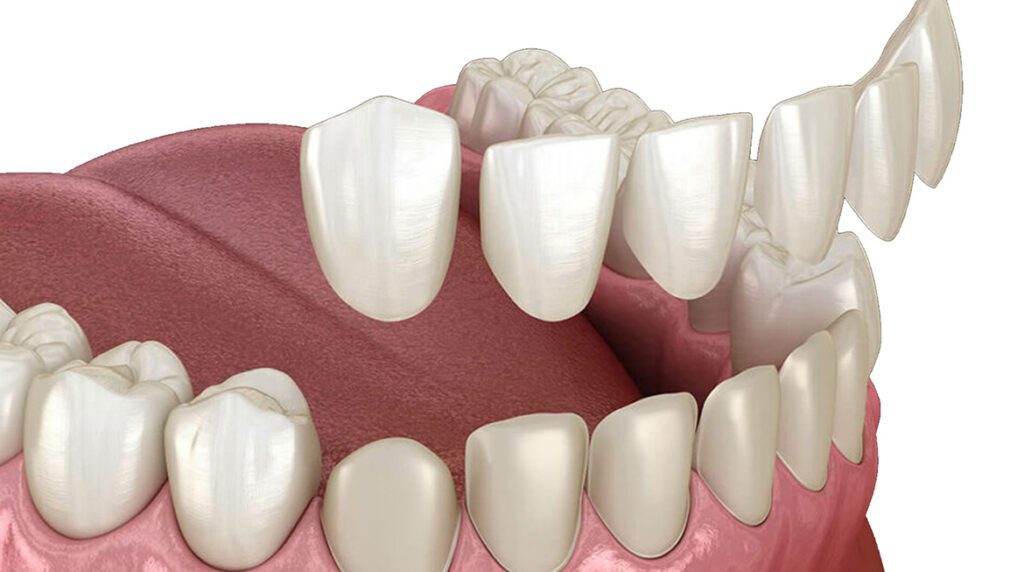 porcelain-veneer treatment in Ludhiana