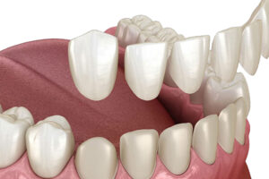 Porcelain Veneers Treatment in Ludhiana