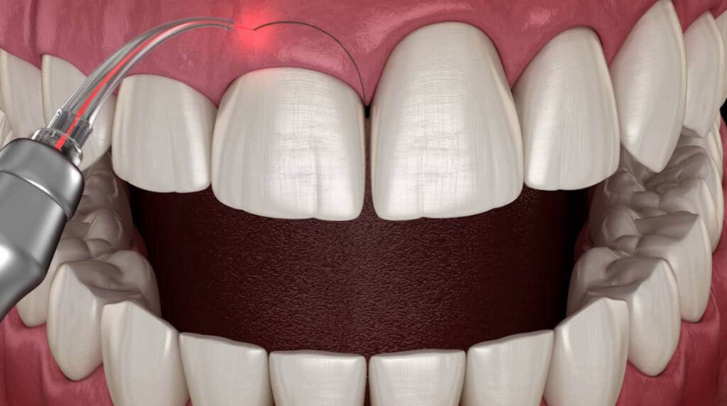 Gum Contouring and Reshaping in Ludhiana