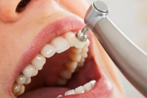 Teeth Cleaning Cost in Ludhiana