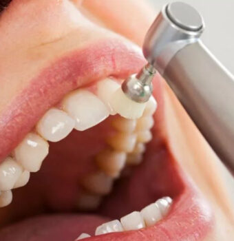 Teeth Cleaning Cost in Ludhiana