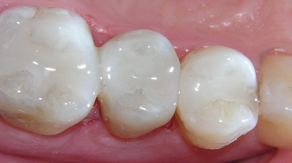 composite filling cost in ludhiana