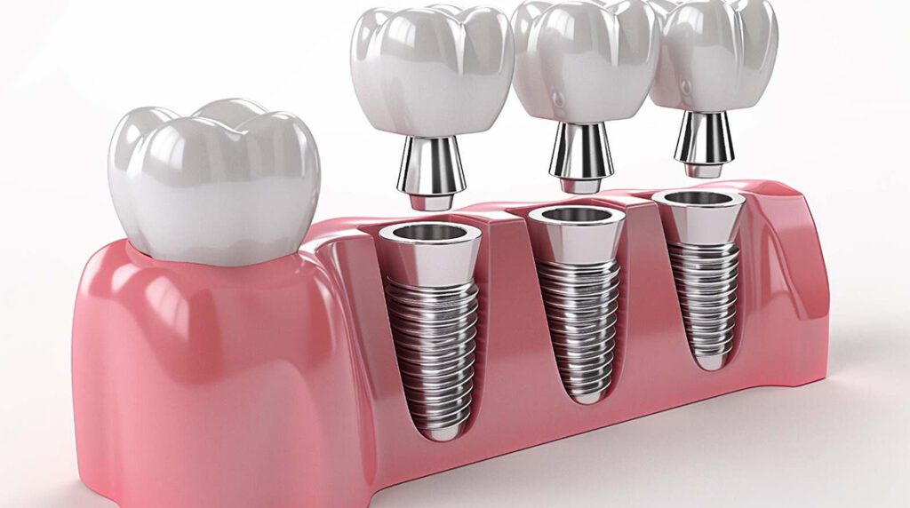 dental implants in year 2025