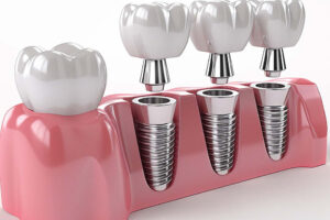 Dental Implants in 2025: The Ultimate Solution for a Perfect Smile