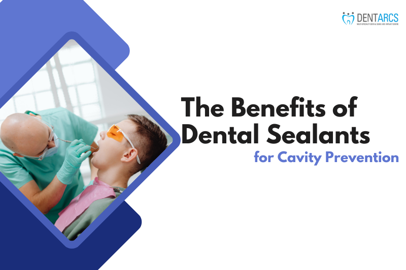 The Benefits of Dental Sealants for Cavity Prevention