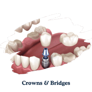 dentarcs dental care-Crowns & Bridges