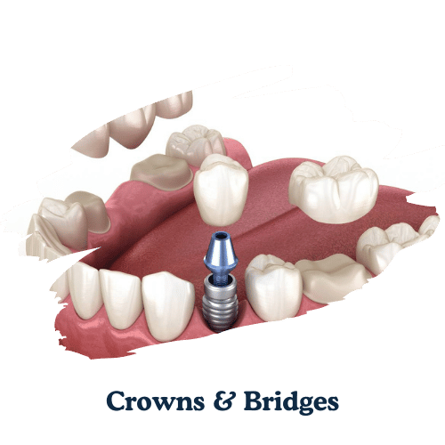 dentarcs dental care-Crowns & Bridges