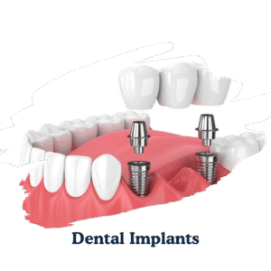 dentarcs dental care-Dental Implants