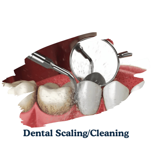 dentarcs dental care-Dental Scaling Cleaning