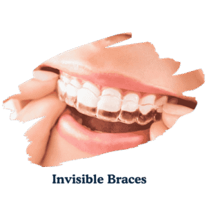 dentarcs dental care-Invisible Braces