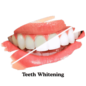 dentarcs dental care-Teeth Whitening